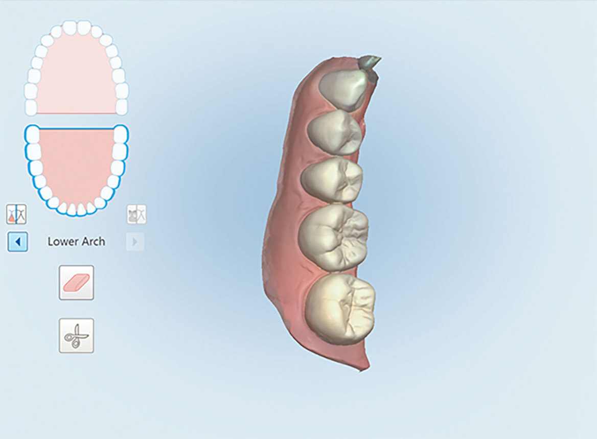 digital intraoral scans